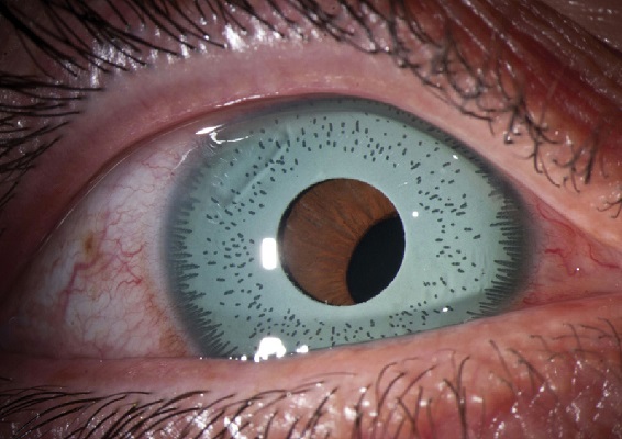 Cosmetic Iris Implant. Decentered Iris implant. The pupil is not aligned