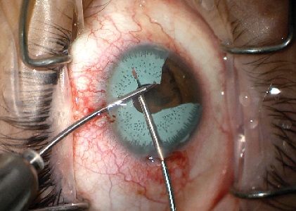 Surgical removal of iris implant due to complications