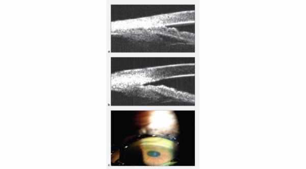 Angle Closure Glaucoma by Ultrasound biomicroscopic. A- Showed contact between iris and cornea and closure of the Angle. B- The angle is opened after treatment. C-Indentation gonioscopy. © 2019 American Academy of Ophthalmology