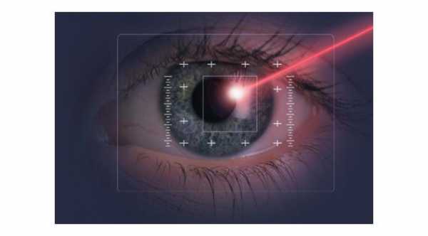 Cataract Laser Surgery