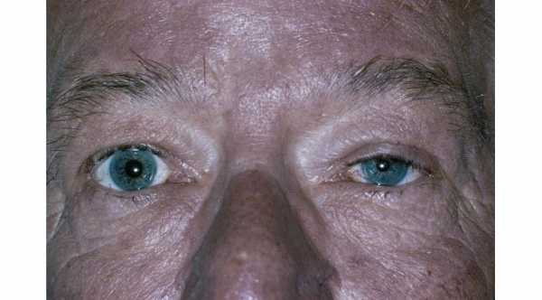 Causes of Ptosis. Horner Syndrome © 2019 American Academy of Ophthalmology 