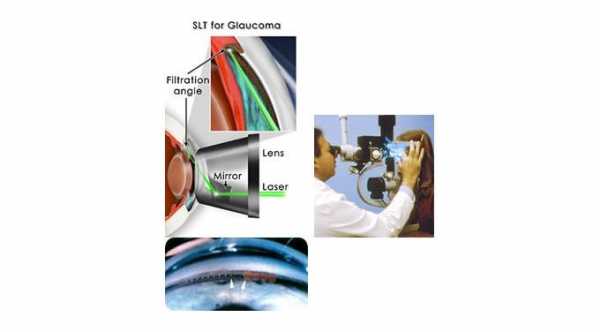 Glaucoma Laser Surgery. Laser Trabeculoplasty for Glaucoma Treatment