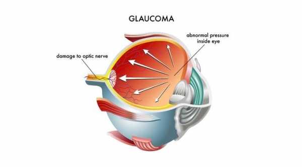 Normal Pressure Glaucoma