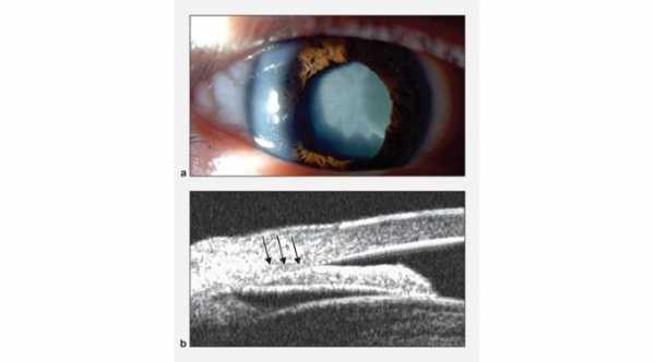 Phacomorphic glaucoma. A- Cataract B-ultrasound biomicroscopy Shows angle closure from cataract.© 2019 American Academy of Ophthalmology