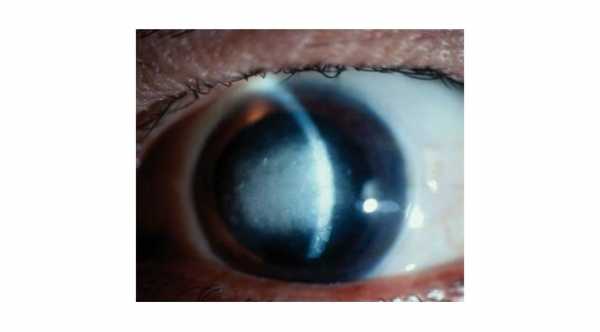 Stromal Herpetic Keratitis with central corneal opacity and corneal edema