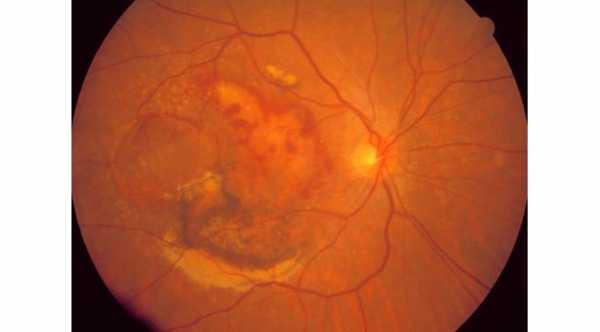 Types of Age Related Macular Degeneration. Wet Age Related Macular Degeneration with subretinal blood and exudates due to CNV © 2019 American Academy of Ophthalmology