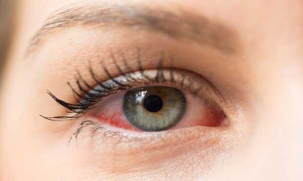 What are the Causes of Dry Eyes