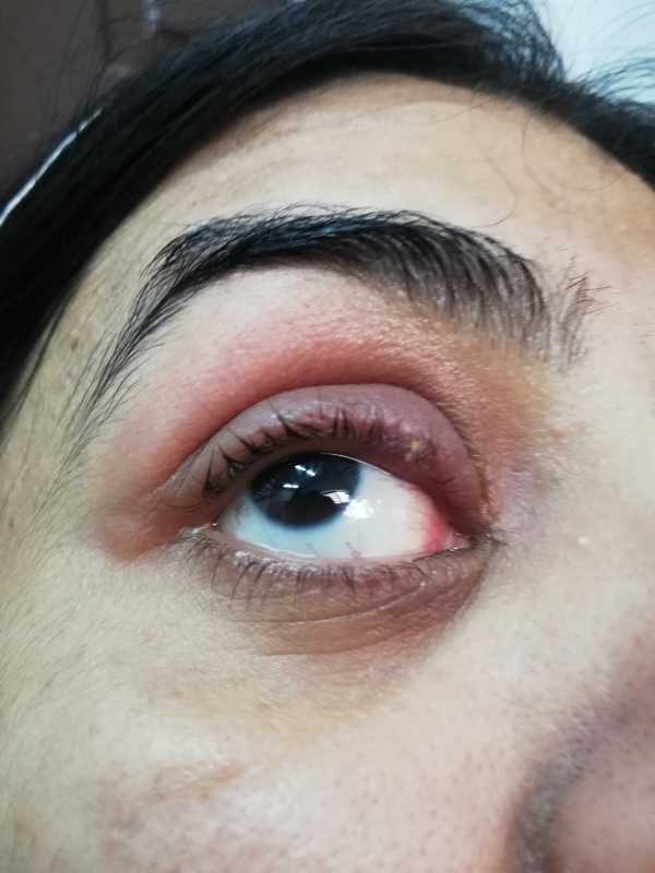 Swelling of upper eyelid-1