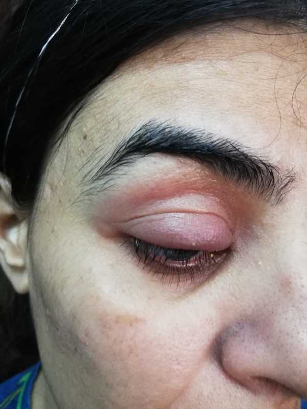Swelling of upper eyelid-2