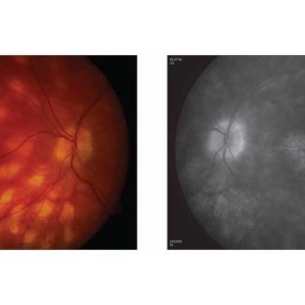 Birdshot Chorioretinopathy. Multiple subretinal white spots that radiate from optic disc© 2019 American Academy of Ophthalmology