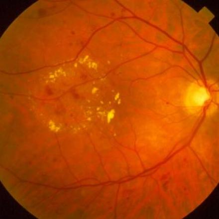 Diabetes and Eyesight. Diabetic Retinopathy shows macular edema and exudates© 2019 American Academy of Ophthalmology