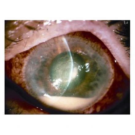 Eye Infection from Contact Lens . Whitish intraocular debris which is called hypopyon with corneal edema © 2019 American Academy of Ophthalmology