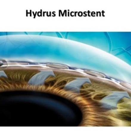 Hydrus Microstent for Glaucoma