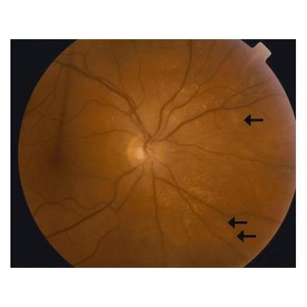 Sympathetic Ophthalmia with Dalen Fuchs nodules or hypopigmented lesions © 2019 American Academy of Ophthalmology