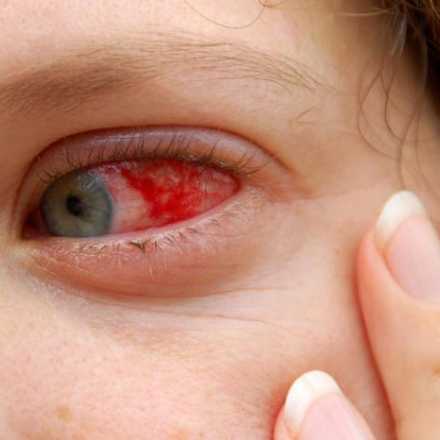 Can high blood pressure cause bloodshot eyes?