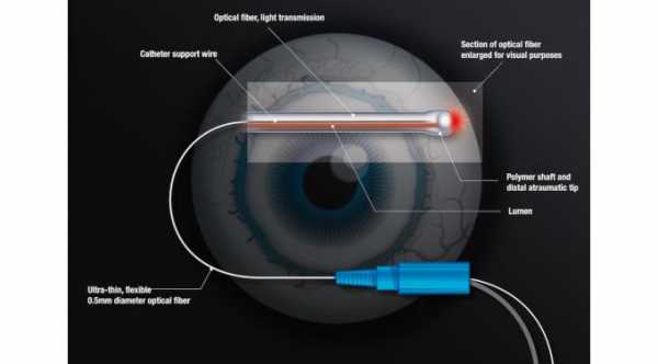 ABiC Procedure intraocular pressure
