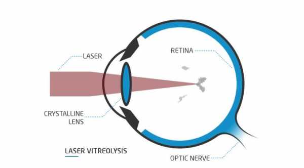 YAG Laser Vitreolysis For Eye Floaters