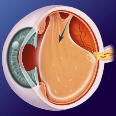 Posterior Vitreous Detachment . Vitreous is detached from the retina © 2019 American Academy of Ophthalmology