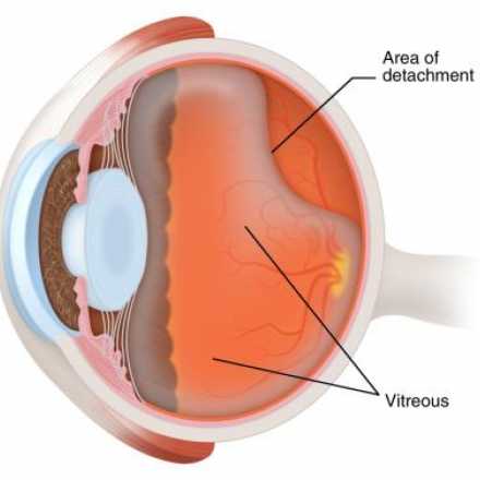 Eye Floaters Treatment