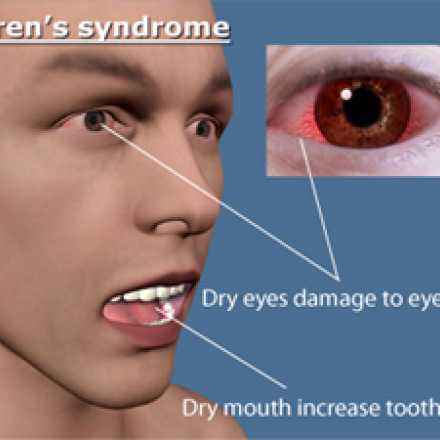 Sjogrens Disease with dry eyes and dry mouth