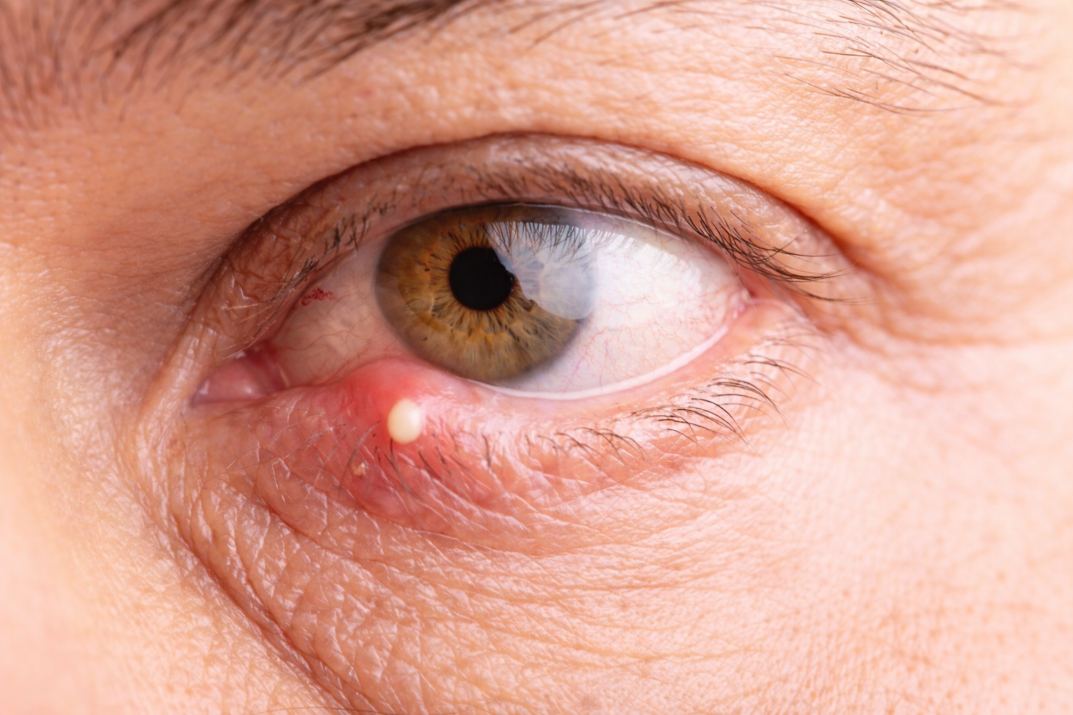 Close-up photo of an eye stye on the lower eyelid showing a swollen red bump caused by an infected oil gland.